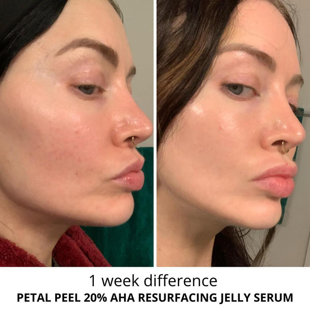 💫 PETAL PEEL 20% Resurfacing Jelly Serum